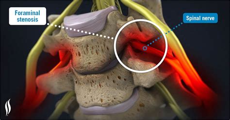 neural foramen neck distraction